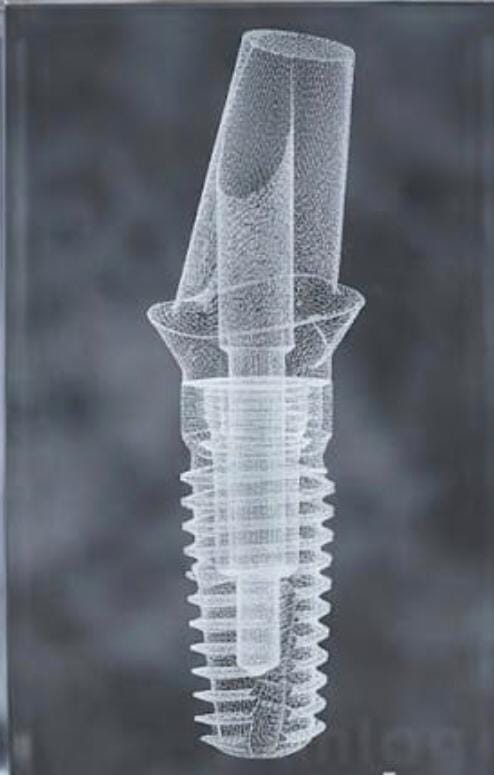 Implantat Darstellung